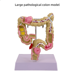 बड़ी आंत पैथोलॉजी मॉडल सिलिकॉन अंग और गैस्ट्रोइंटेस्टाइनल और कोलन रोग के लिए हेड मॉडल - Product Image 6