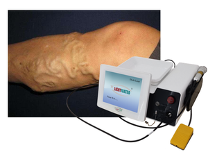 Evlt EVLA Diodo de Ablación Endovascular Láser 1470nm Dispositivo de Diodo para Venas Varicosas <span class=keywords><strong>Piernas</strong></span> Venas Prominentes Dolor de <span class=keywords><strong>Piernas</strong></span> - Product Image 2