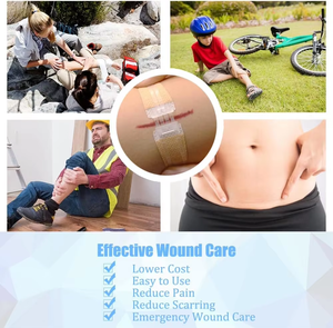 อุปกรณ์ปิดแผลฉุกเฉิน ชุดอุปกรณ์ปิดแผลด้วยโอโซนพร้อมแถบซิปสติทช์ ชุดเย็บแผล แผ่นปิดแผลชนิดซิปสติทช์ สำหรับซ่อมแซมแผลระดับ Class I ผลิตแบบ OEM - Product Image 2