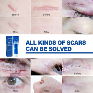 OEM Meilleure crème <span class=keywords><strong>pour</strong></span> l'élimination des cicatrices de brûlures d'acné Stria Gravidarum Chirurgical Pimple New Old Scar Removal Cream <span class=keywords><strong>pour</strong></span> enlever les cicatrices - Product Image 3