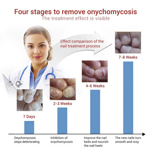 Solution réparatrice pour les ongles <span class=keywords><strong>SUAI</strong></span> : Soin et réparation de l'onychomycose des mains et des pieds pour les ongles épaissis et abîmés par les champignons - Product Image 6