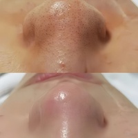 Lotion Exfoliante Visage Nettoyante en Profondeur 500g à la Vitamine E Naturelle pour Soin de la Peau, Effets Blanchissants, Élimination des Points Noirs et Points Blancs, Usage Professionnel en Salon