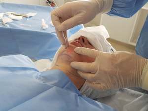 Peralatan Bedah Fiberlifting Lipolisis <span class=keywords><strong>Laser</strong></span> Diode 980nm+1470nm <span class=keywords><strong>Liposuction</strong></span> Endolaser Pengencang Kulit Kanula Fiber - Product Image 2