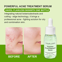 Puissant sérum d'huile d'arbre à thé d'acide salicylique 2% pour le traitement de l'acné réduction rapide des imperfections acné sévère visage liquide revitalisant