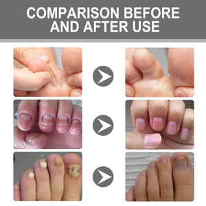 Traitement <span class=keywords><strong>antifongique</strong></span> pour les ongles Ximonth, crème de soin des ongles <span class=keywords><strong>antifongique</strong></span>, 30g - Product Image 4