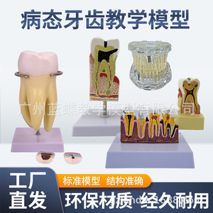 Molares ampliados 3 veces, patología dental completa, dientes transparentes, caries dentales, enseñanza de comunicación con pacientes dentales - Product Image 1