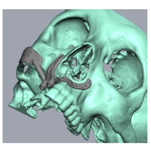 ซัพพลายเออร์อินเดียจำหน่ายรากฟันเทียมไทเทเนียมแบบ Maxillary พร้อมดีไซน์เกลียวเรียวเพื่อการยึดติดแน่นสำหรับการทดแทนฟันบน มีจำหน่ายแล้ว - Product Image 6