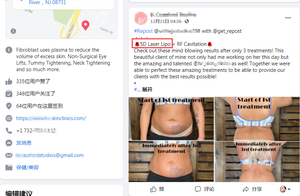 Máquina de liposucción láser 5D Diodo Láser Quema de grasa Anticelulitis Estiramiento DE LA PIEL Almohadillas láser Dispositivo de terapia no invasiva - Product Image 6