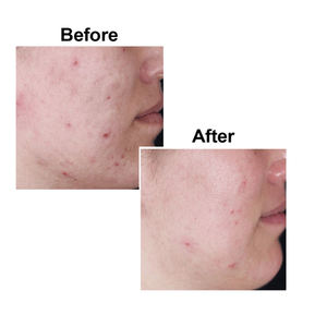 <span class=keywords><strong>Savon</strong></span> Purifiant et Blanchissant Original à l'Acide Kojique avec Huile de Coco et Huile d'<span class=keywords><strong>Arbre</strong></span> à Thé Rafraîchissante pour Éliminer les Taches Brunes - Product Image 3