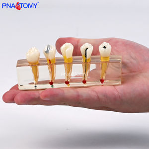 PNATOMY, modelo terapéutico patológico Dental de 5 componentes, muestra lesiones de caries, pulpa necrótica, absceso apical de plástico - Product Image 5