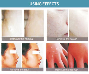 2026 Neueste Ion Dot Mole Pen Schnelle Behandlung ohne Narben zu verlassen könnte sofort funktionieren, ohne dass eine Wiederherstellung periode erforderlich ist - Product Image 5