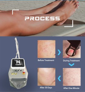 Appareil <span class=keywords><strong>de</strong></span> beauté <span class=keywords><strong>laser</strong></span> CO2 fractionné fixe Shandong Huamei pour le rajeunissement cutané, l'élimination des cicatrices et le resserrement vaginal - Product Image 4