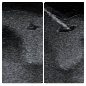 Modulo di Addestramento per Puntura Guidata ad Ultrasuoni della Tiroide, con Lesioni Bilaterali, Dimensioni Reali della Tiroide, Pratica di Biopsia nella Regione del Collo, Modello Fantoccio - Product Image 3