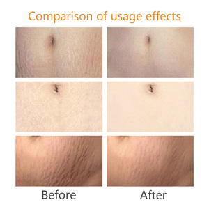 Crème anti-vergetures puissante de haute qualité avec de l'<span class=keywords><strong>huile</strong></span> de graines de tournesol pour améliorer l'élasticité de la peau, la prévention et la réparation - Product Image 5