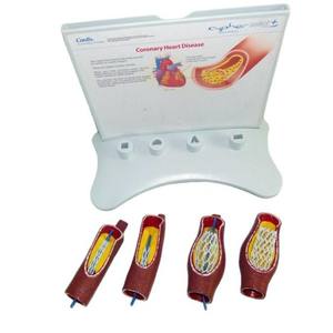 कोरोनरी हृदय रोग के लिए शैक्षिक उपकरण 4-चरण स्टेंट तैनाती प्रदर्शन मॉडल - Product Image 5