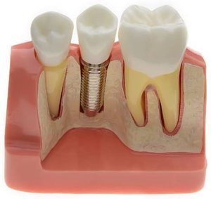 Gelsonlab HSDT-M3 4 Volte <span class=keywords><strong>Implant</strong></span> Denti Modello Dentale Modello di Impianto Analisi <span class=keywords><strong>Crown</strong></span> Ponte Dimostrazione Denti Modello per la Formazione - Product Image 2