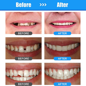 Kit de Gel Moldeable <span class=keywords><strong>para</strong></span> Dientes - Relleno Dental Temporal y Set de Reparación de Dentaduras <span class=keywords><strong>para</strong></span> Maquillaje de Fiesta, Cubierta Dental Cosmética - Product Image 3