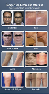 Hệ thống massage tuần hoàn 360 ° để giảm cellulite và tăng cường trao đổi chất giảm béo - Product Image 6