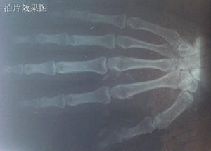 Goedkope Prijs Draagbare Menselijk Gebruikt Ziekenhuis Kliniek Mobiele X-Ray Machine Met Goede Kwaliteit - Product Image 4