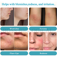 Vaporisateur d'acide hypochloreux HOCl Brume faciale pour peau sensible, rougeur, irritations, eczéma, pulvérisation de molécule d'acné