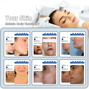 Máquina 14 en 1 para Hidrofacial, Aqua Peel, Lifting Facial, Dermoabrasión, Cuidado de la Piel, Oxígeno, Chorro de Agua, Spa - Product Image 4