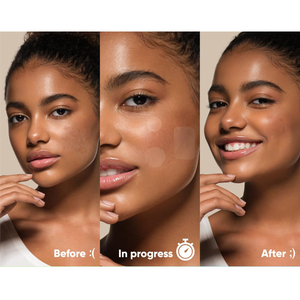 Cubierta absorbente Punto de imperfecciones para zits imperfecciones puntos blancos hidrocoloide Acné Parche de espinillas - Product Image 6