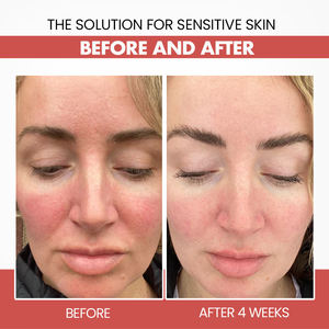 Réduire les rougeurs ensemble de soins de la peau sensible meilleurs produits <span class=keywords><strong>bio</strong></span> naturel rapide apaiser réparation restaurer la peau visage sérum ensemble de soins de la peau nouveau - Product Image 5