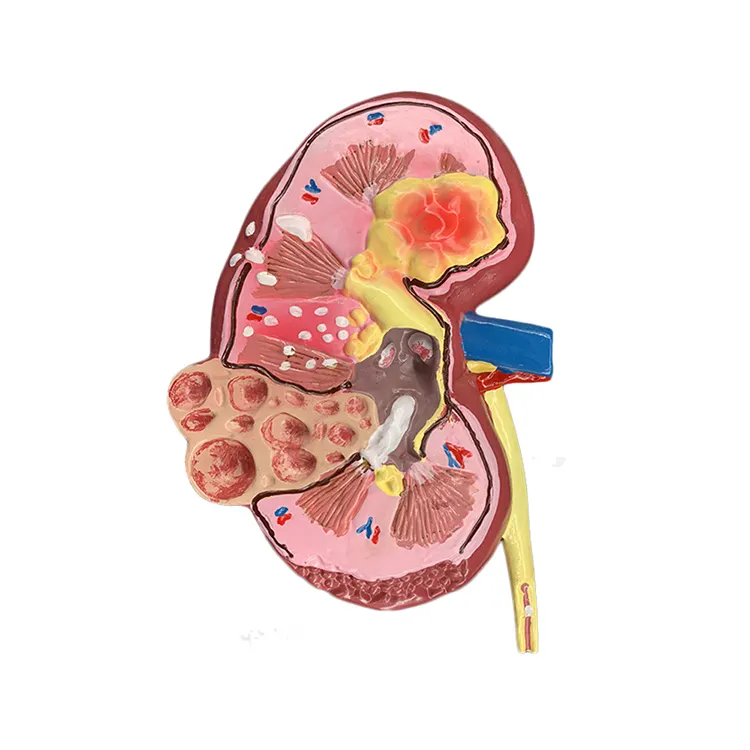 26.5x15x11cm microstructure human two sided diseased kidney anatomy model for school education