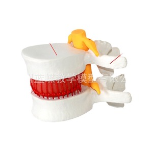 Modèle de démonstration de compression des disques intervertébraux lombaires humains, modèle d'agrandissement de la colonne vertébrale lombaire, colonne vertébrale pathologique - Product Image 1