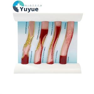 แบบจำลองหลอดเลือดแบบไดนามิก การเปรียบเทียบการอุดตันของคราบไขมันในหลอดเลือดแดงสำหรับการ<span class=keywords><strong>สอน</strong></span>ทางการแพทย์ - Product Image 1