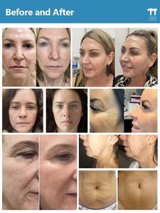 Máquina de Microagujas 2026, Eliminación de Arrugas, Reafirmación de la Piel, Pérdida de Peso Facial para Clínicas Estéticas - Product Image 5