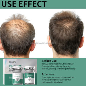 Marque privée Facteur de croissance efficace Repousse des cheveux <span class=keywords><strong>Poudre</strong></span> lyophilisée Cellules souches Soin du cuir chevelu Sérum Exosoma Booster de cheveux - Product Image 4