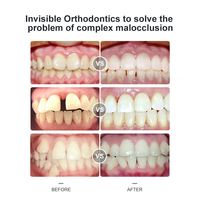 Fabriqué en Chine, aligneurs transparents Invisalign, aligneurs transparents, appareils orthodontiques, appareils en silicone, appareils dentaires multi-usages