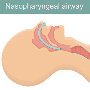 Cánula Nasofaríngea Estéril Medresq, Tubo Nasofaríngeo de PVC, Cánula Nasofaríngea Desechable con Lubricante - Product Image 5