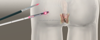 Bonne qualité 980nm meilleurs traitements des hémorroïdes fistule fissure Pilonidal Sinus dispositif