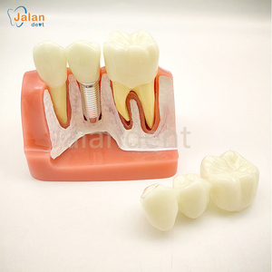 Dentaire Bon Prix Dentaire Enseigner Dent Modèle Caries Dentaires Développement Modèle - Product Image 2