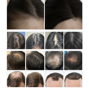Sistema Multifuncional para el Crecimiento del Cabello con Pulverizador de Oxígeno y Cepillo Bio Fotoeléctrico para el Tratamiento de la <span class=keywords><strong>Alopecia</strong></span> <span class=keywords><strong>Androgenética</strong></span> - Product Image 4