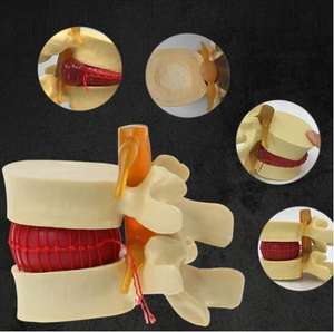 Lumbar Spine Model Intervertebral Disc Model Diseased Lumbar Spine Model - Product Image 3