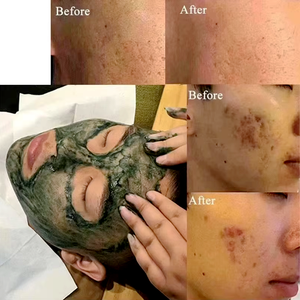Sérum en Poudre de Spicules de Spongille à Microneedle OEM/ODM, Bio Peeling aux Algues Vertes pour Usage en Salon, Élimination de l'Acné, Peeling aux Algues - Product Image 2