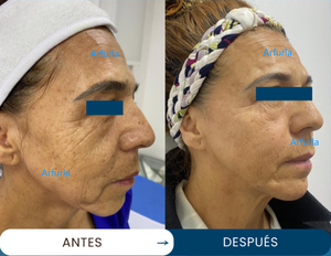 Máquina de Lipólisis con Resultados Efectivos, 980nm 1470nm, Máquina Endoláser de Alta Potencia, Lifting Facial, Lipólisis Láser, Máquina de Liposucción - Product Image 4