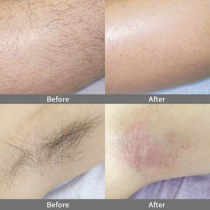 2025 más nuevo Alemania diodo láser 808nm Diodo Láser Depilación máquina precio para la venta 1600W - Product Image 6