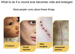 Fabriek Biedt Ziekenhuis Medische Steri-Strip Tape Chirurgische Wondsluiting Versterkte Huid Medische Verbruiksartikelen Steriel - Product Image 4