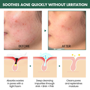 Cuidado DE LA PIEL Tratamiento del acné Aha Pha Bha Blemish Eliminar incluso la textura de la piel Solución de <span class=keywords><strong>peeling</strong></span> facial Suero Exfoliante para la cara - Product Image 2