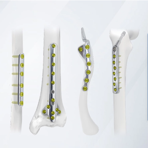 Sistem Implan Fiksasi Kompresi Trauma Fraktur Tulang Bedah Ortopedi Titanium VA <span class=keywords><strong>Distal</strong></span> Lateral Tibia Locking Plate - Product Image 3