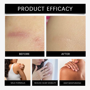 Crème de soin du corps à base de plantes ecchymoses eczéma rougeur gonflement traitement crème hydrater réparation élimination des cicatrices réparation des cicatrices pour adultes - Product Image 2