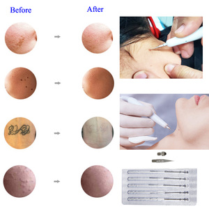 Portátil verrugas mancha remoção caneta alta freqüência Cautery beleza Spa pele Tag e Mole remoção máquina - Product Image 6