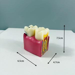 การผลิตแบบจำลองช่องปากจากผู้ผลิต จำหน่ายโดยตรง สำหรับการสาธิตการสอนเรื่องฟันผุ แบบจำลองเปรียบเทียบฟันผุ ขยายใหญ่ขึ้น 6 เท่า - Product Image 3