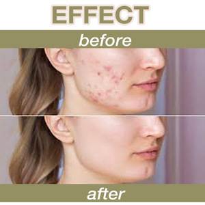 Kit de Espículas de Esponja al por Mayor, Suero Líquido con Ácido Hialurónico y Algas Marinas para el Cuidado Facial, Acné y Pigmentación con Espículas de Esponja Liofilizadas - Product Image 6