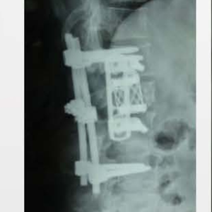 Orthopedische <span class=keywords><strong>Implant</strong></span> Titanium Mesh Met Anterior Platen Cilindrische Interbody Fusion Kooi Prismatische Gat - Product Image 4