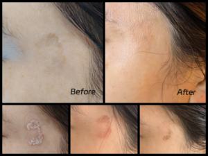 <span class=keywords><strong>Laser</strong></span> médical Nd Yag 755nm 1064nm 532nm PICO pour l'élimination des tatouages et de l'acné, machine 3000W à usage commercial, blanchiment de la peau - Product Image 6